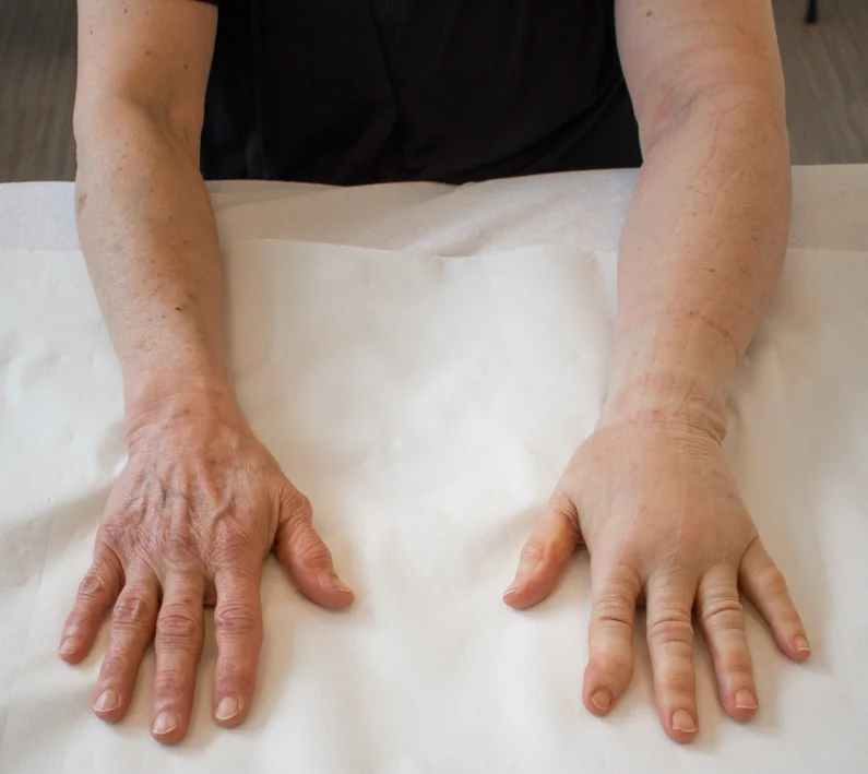 reumatoide artitis