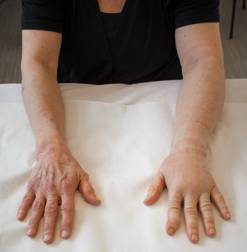 Oedeemtherapie Fyzie 