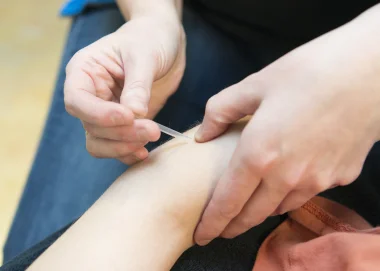 Dry needling - Fyzie